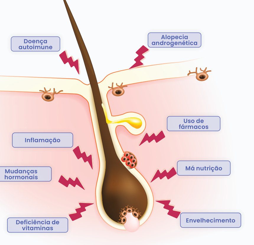 Figura 1: folículo piloso afetado por doença autoimune, alopecia androgenética, uso de fármacos, inflamação, má nutrição, mudanças hormonais, deficiência de vitaminas e envelhecimento