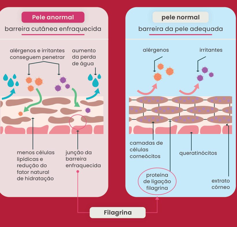 Figura 1: comparação entre a pele com eczema, com barreira cutânea enfraquecida (alérgenos e irritantes penetram, há aumento da perda de água, menos lipídios e redução do fator natural de hidratação, junção da barreira enfraquecida) e a pele normal, com barreira adequada (camadas de corneócitos, queratinócitos, extrato córneo e proteína de ligação filagrina)
