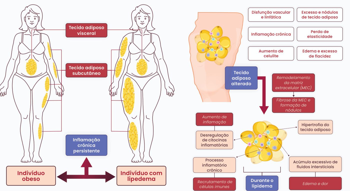 Figura 2: comparação entre indivíduo obeso (gordura visceral) e indivíduo com lipedema (gordura subcutânea desproporcional nos membros), ambos com inflamação crônica persistente; no lipedema, o tecido adiposo alterado passa por remodelamento e fibrose da matriz extracelular com formação de nódulos, hipertrofia, desregulação de citocinas, recrutamento de células imunes e acúmulo de fluidos, levando a edema e dor