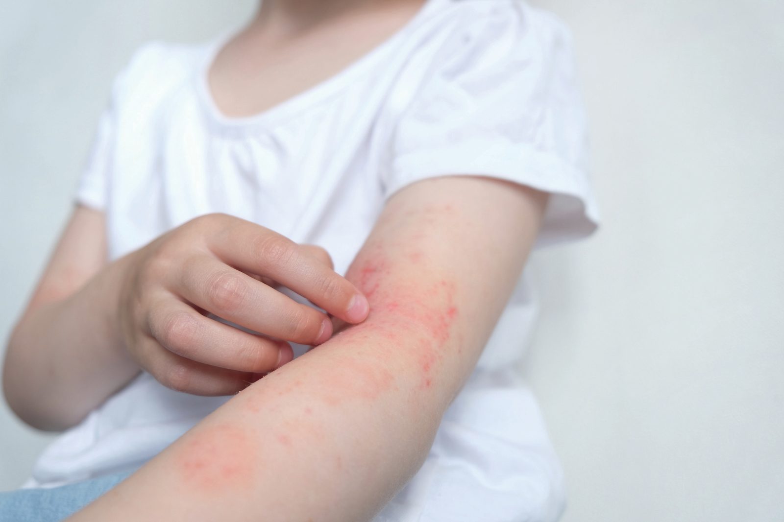 Criança coçando o braço com lesões avermelhadas de dermatite