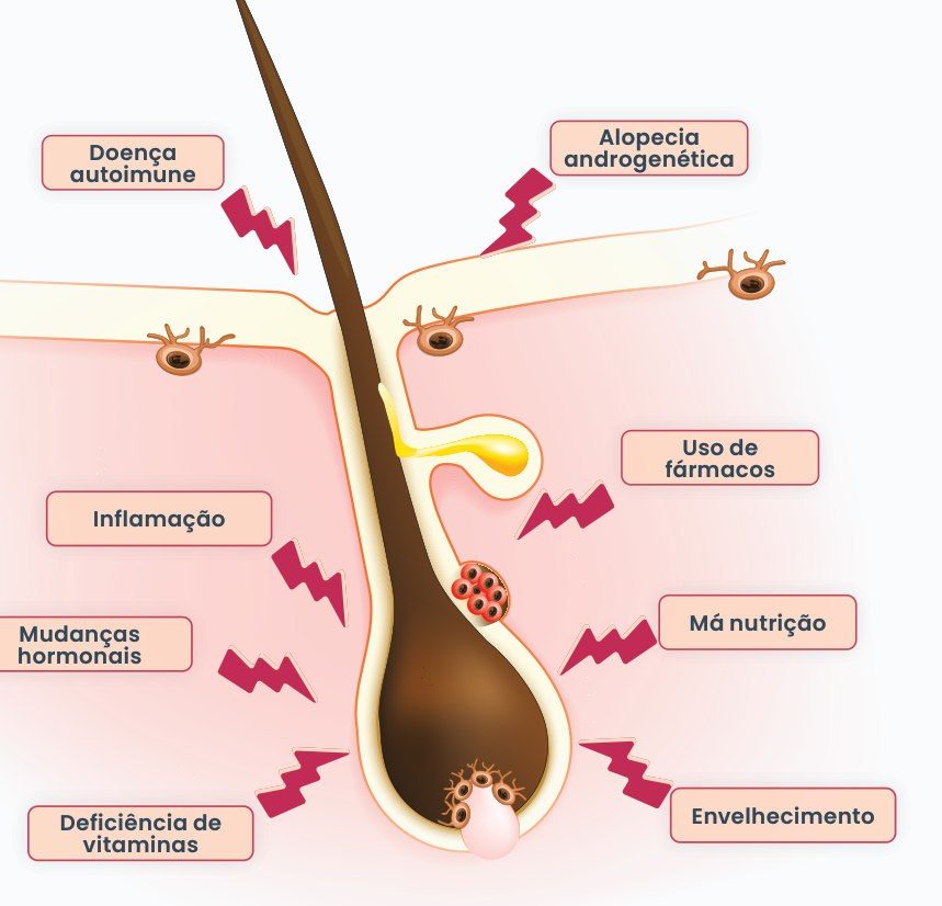 Figura 1: folículo piloso afetado por doença autoimune, alopecia androgenética, uso de fármacos, inflamação, má nutrição, mudanças hormonais, deficiência de vitaminas e envelhecimento