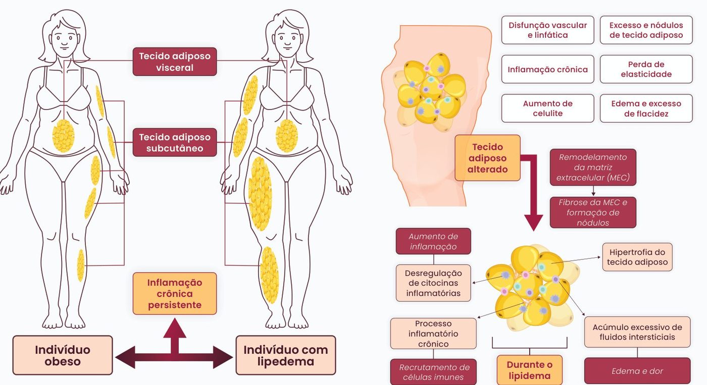 Figura 2: comparação entre indivíduo obeso (gordura visceral) e indivíduo com lipedema (gordura subcutânea desproporcional nos membros), ambos com inflamação crônica persistente; no lipedema, o tecido adiposo alterado passa por remodelamento e fibrose da matriz extracelular com formação de nódulos, hipertrofia, desregulação de citocinas, recrutamento de células imunes e acúmulo de fluidos, levando a edema e dor