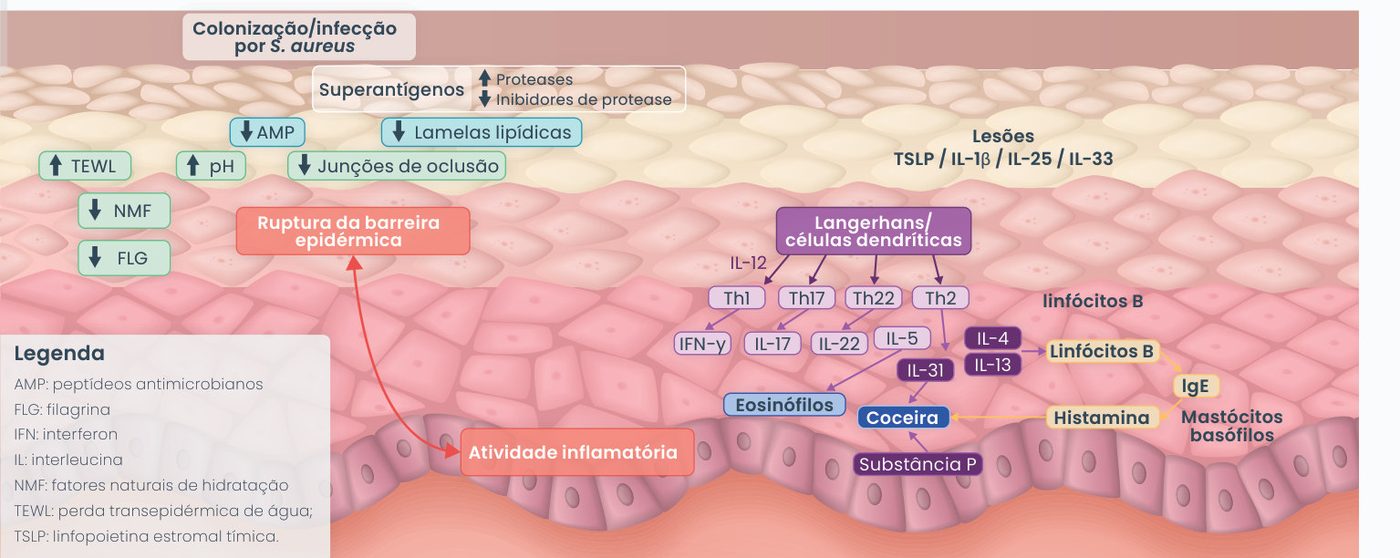 Figura 1: colonização por S. aureus e superantígenos aumentam proteases e reduzem inibidores de protease; ocorre aumento de TEWL e pH e redução de AMP, lamelas lipídicas, junções de oclusão, NMF e filagrina, com ruptura da barreira epidérmica e atividade inflamatória. Nas lesões, TSLP, IL-1β, IL-25 e IL-33 ativam células de Langerhans e dendríticas, que estimulam Th1 (IFN-γ), Th17 (IL-17), Th22 (IL-22) e Th2 (IL-4, IL-5, IL-13, IL-31), levando a eosinófilos, linfócitos B, IgE, mastócitos e basófilos, histamina, substância P e coceira