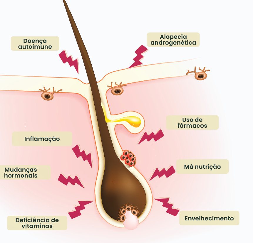 Figura 1: folículo piloso afetado por doença autoimune, alopecia androgenética, uso de fármacos, inflamação, má nutrição, mudanças hormonais, deficiência de vitaminas e envelhecimento