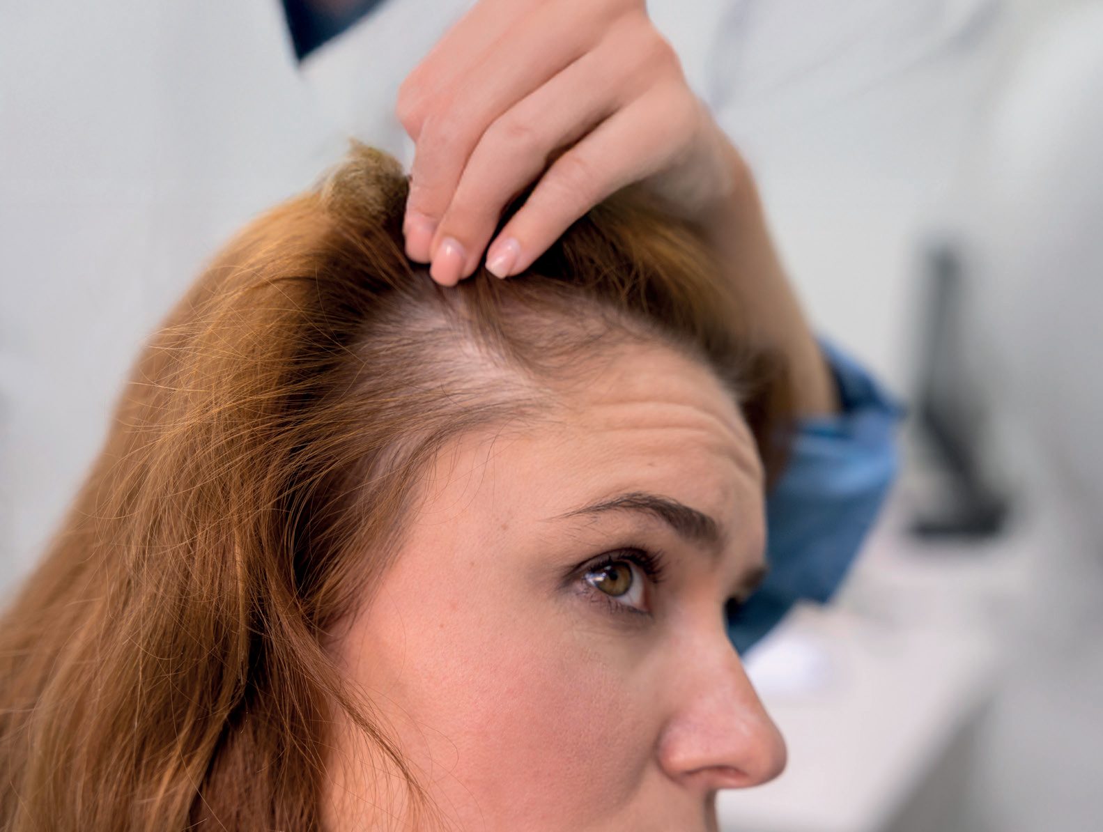 Mulher afastando o cabelo para mostrar a rarefação no couro cabeludo