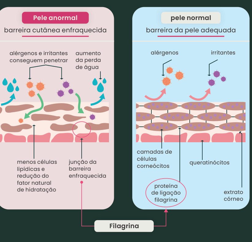 Figura 1: comparação entre a pele com eczema, com barreira cutânea enfraquecida (alérgenos e irritantes penetram, há aumento da perda de água, menos lipídios e redução do fator natural de hidratação, junção da barreira enfraquecida) e a pele normal, com barreira adequada (camadas de corneócitos, queratinócitos, extrato córneo e proteína de ligação filagrina)